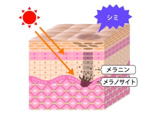 シミの元となるメラニンが発生する原因